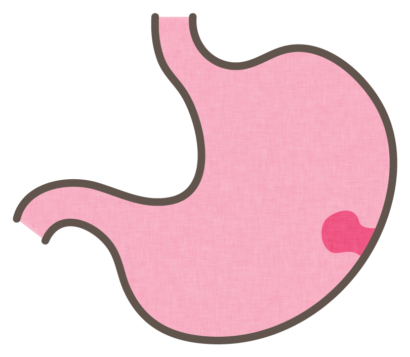 胃のポリープって？｜医療法人 好友会 ひらたクリニック｜古市駅、羽曳野市の消化器内科・内視鏡内科・内科