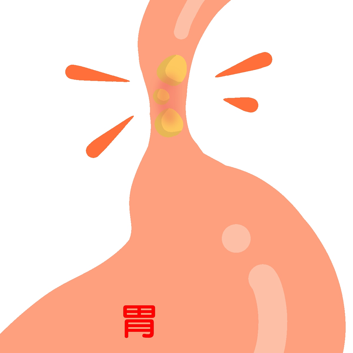 マロリーワイス症候群って？