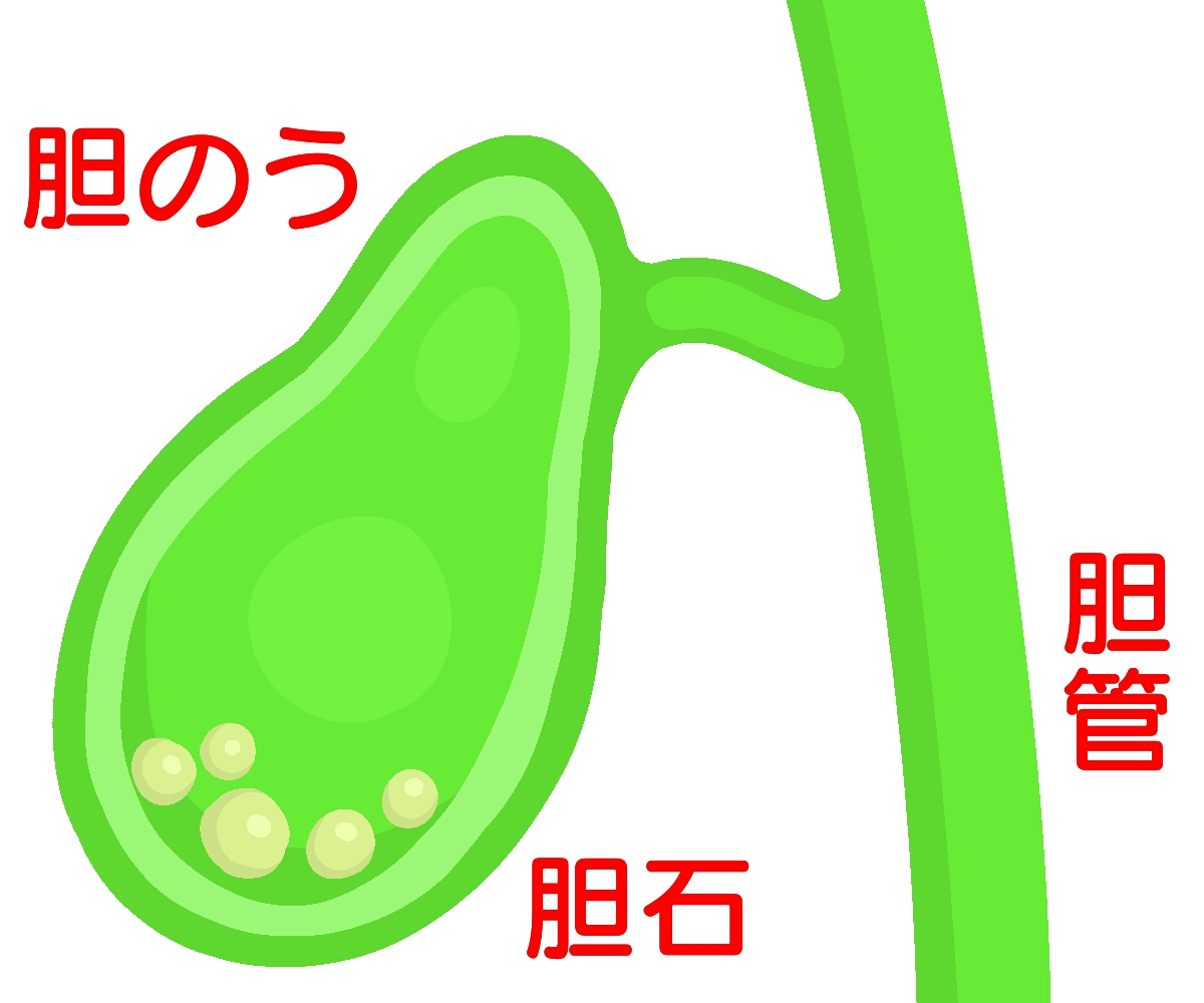 胆石について