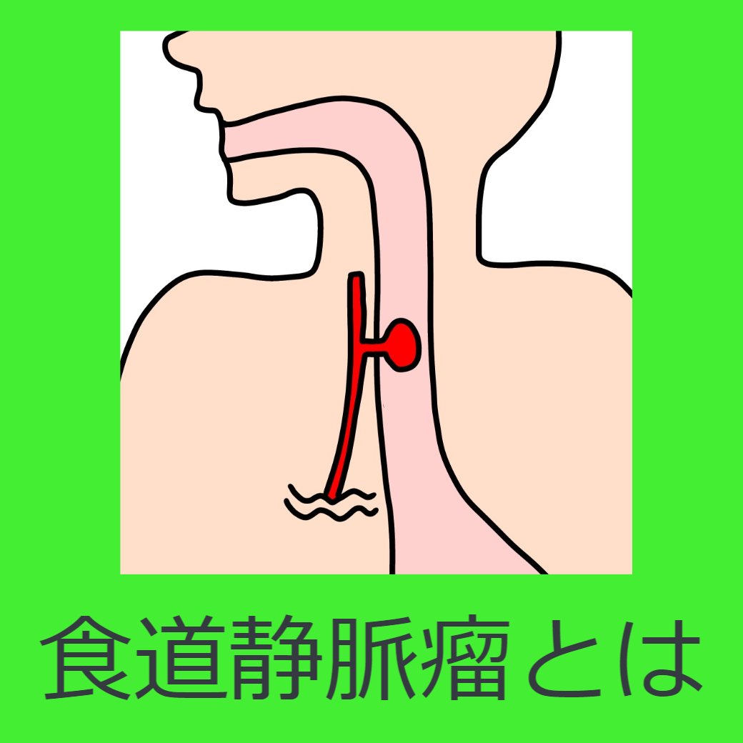 食道静脈瘤とは