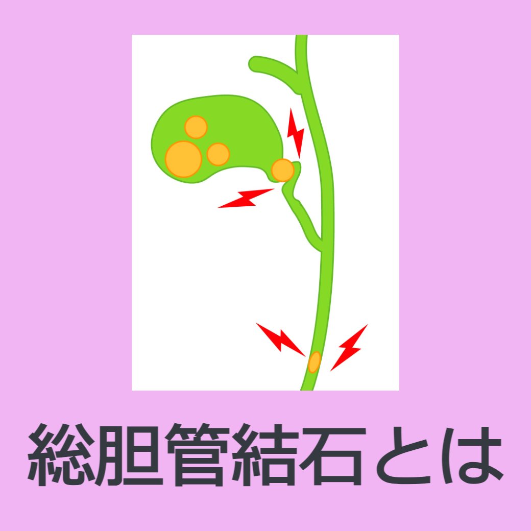 総胆管結石とは