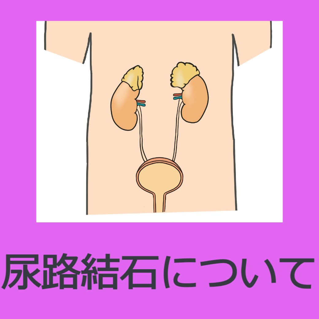 尿路結石について