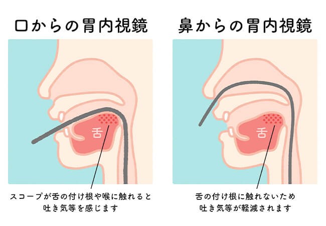 口からの内視鏡、鼻からの内視鏡の解説イラスト