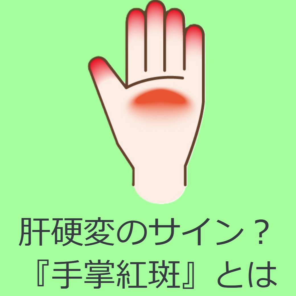 肝硬変のサインかもしれない「手掌紅斑（しゅしょうこうはん）」とは？